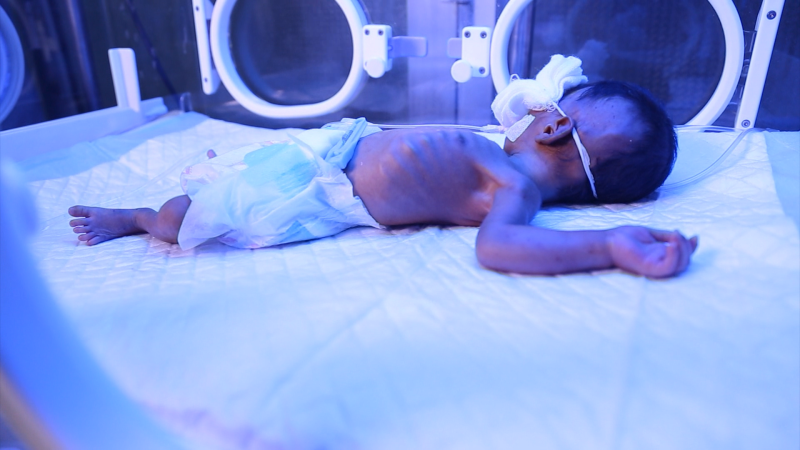 Aangeboren afwijkingen door oorlog en hongersnood in Jemen